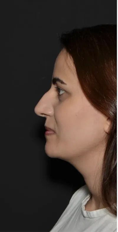 ÖNCE