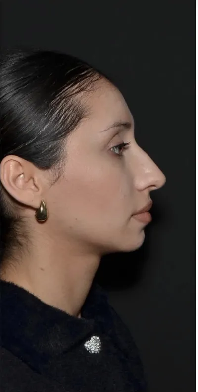 ÖNCE